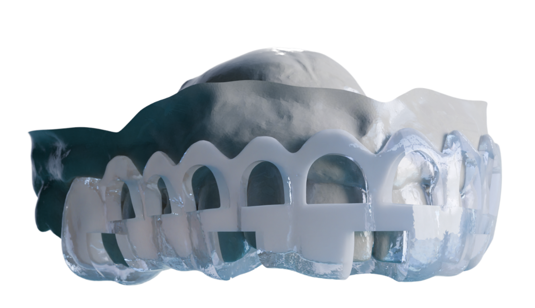 Guide de gingivectomie